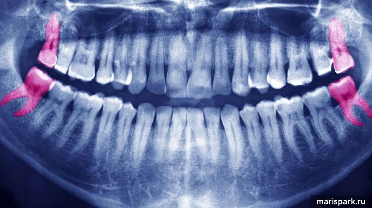 Восьмые зубы и брекеты совместимы в редких случаях
